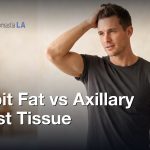 Tejido mamario axilar vs Grasa en la axila — ¿Cómo diferenciarlos?