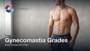 Gynecomastia Grades: Breast Enlargement In Men