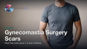 Gynecomastia Surgery Scars: What They Look Like at 1, 6, and 12 Months, Gynecomastia Centers of Los Angeles