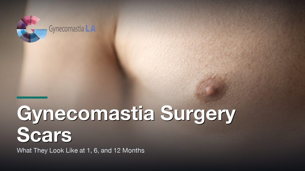 Gynecomastia Surgery Scars: What They Look Like at 1, 6, and 12 Months, Gynecomastia Centers of Los Angeles