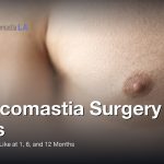 Gynecomastia Surgery Scars: What They Look Like at 1, 6, and 12 Months, Gynecomastia Centers of Los Angeles