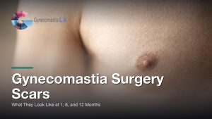 Gynecomastia Surgery Scars: What They Look Like at 1, 6, and 12 Months, Gynecomastia Centers of Los Angeles