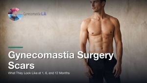 Gynecomastia Surgery Scars: What They Look Like at 1, 6, and 12 Months, Gynecomastia Centers of Los Angeles