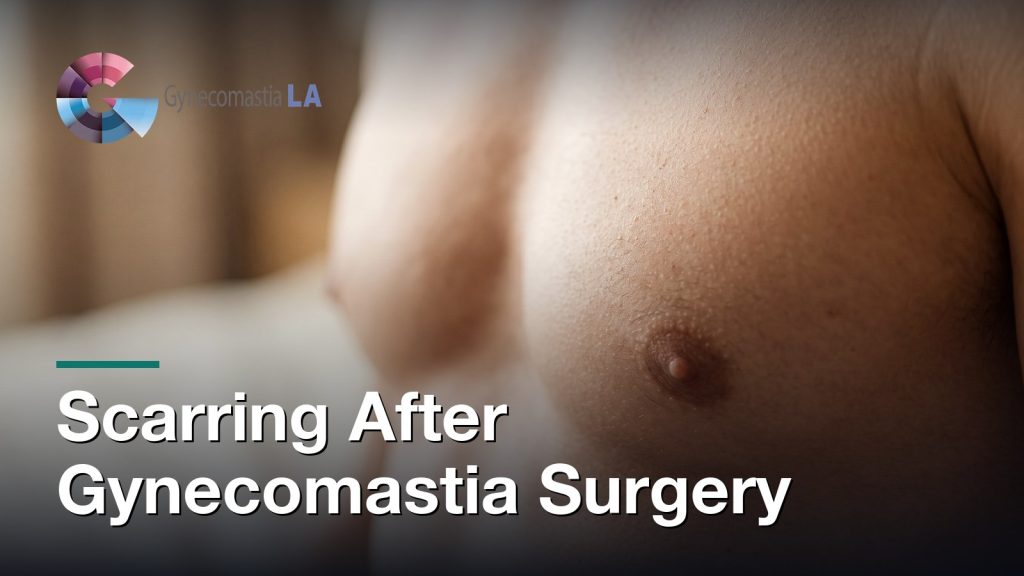 Scarring After Gynecomastia Surgery, Gynecomastia Centers of Los Angeles