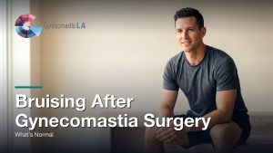 Bruising After Gynecomastia Surgery: What’s Normal, Gynecomastia Centers of Los Angeles