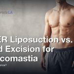 VASER Liposuction vs. Gland Excision for Gynecomastia: What’s the Difference?, Gynecomastia Centers of Los Angeles