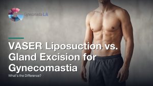 VASER Liposuction vs. Gland Excision for Gynecomastia: What’s the Difference?, Gynecomastia Centers of Los Angeles